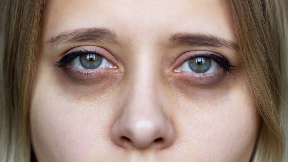 Dark Circles Under The Eyes: Causes & Treatments