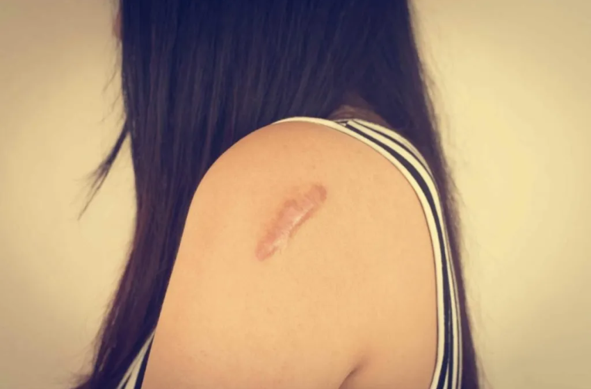  How Long Does It Take for Keloid Treatment to Work?