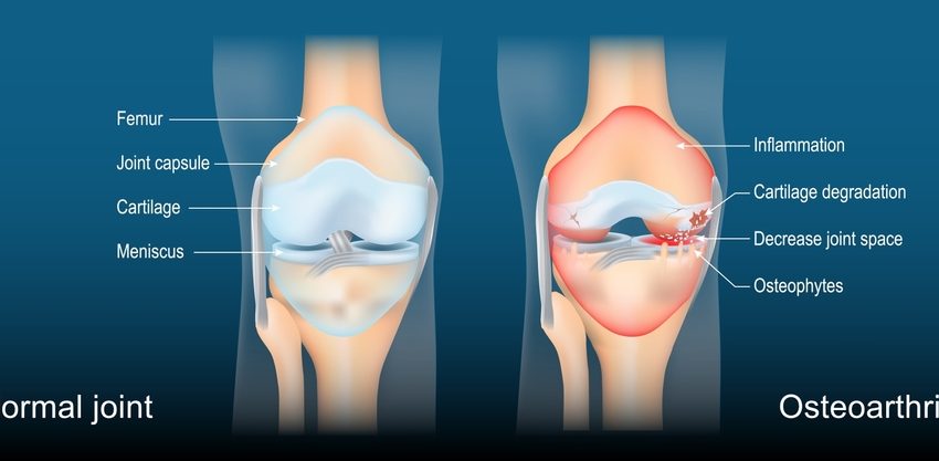  How Tricompartmental Osteoarthritis Affects Daily Life: Coping Strategies for Patients